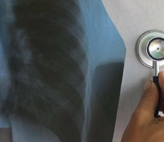 На Чернігівщині захворюваність на туберкульоз зросла майже на 19%: за 2025 рік захворіли 328 людей