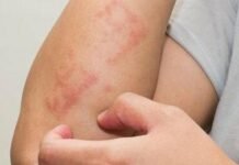 На Чернігівщині зростає кількість випадів корости: найбільше хворих серед дітей