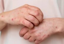 Четвертий випадок від початку року: на Чернігівщині знову зафіксували кір у дітей