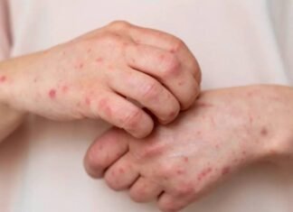 Четвертий випадок від початку року: на Чернігівщині знову зафіксували кір у дітей