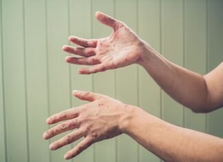 Троє дітей захворіли на кір після відпочинку на Закарпатті: на Чернігівщині закликають перевірити щеплення
